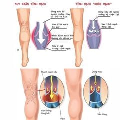 Máy nén ép trị liệu suy giãn tĩnh mạch chân Kachi MK394
