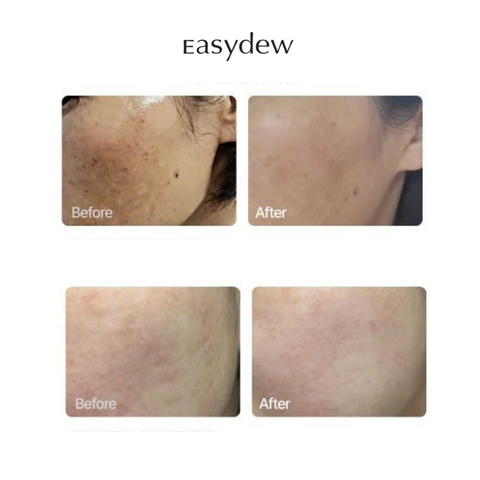  Ống Tinh Chất Chống Thâm Nám, Tái Sinh Trẻ Hóa Làn Da Easydew DW-EGF Melatoning Oneday Ampoule  (1ml*7 ống) 