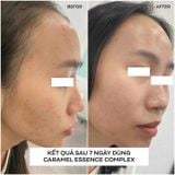  [Combo Quà Tặng] Serum Giảm Mụn, Mờ Thâm Chucos Caramel Essence Complex 10ml + Gel cấp ẩm Water Aid 50gr 