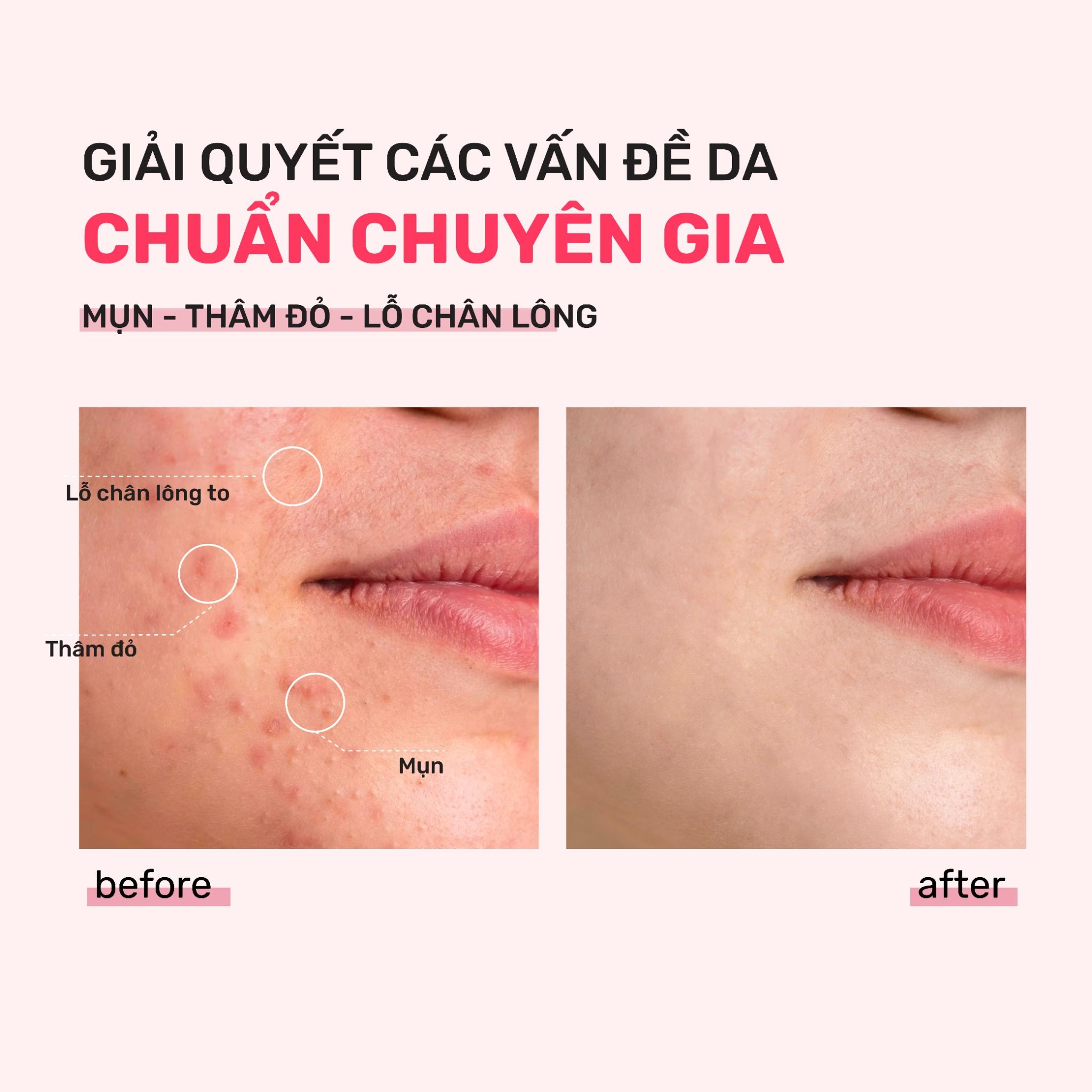  SERUM DERLADIE GIẢM MỤN, MỜ THÂM ĐỎ VÀ THU NHỎ LỖ CHÂN LÔNG DERLADIE LABORATOIRE PORE TIGHTENING AMPOULE NIACINAMIDE 20% + ZINC PCA 1% 30ml 