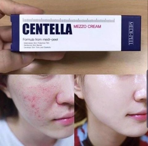 Kem Trị Mụn Medi Peel Centella Mezzo Cream 30ml