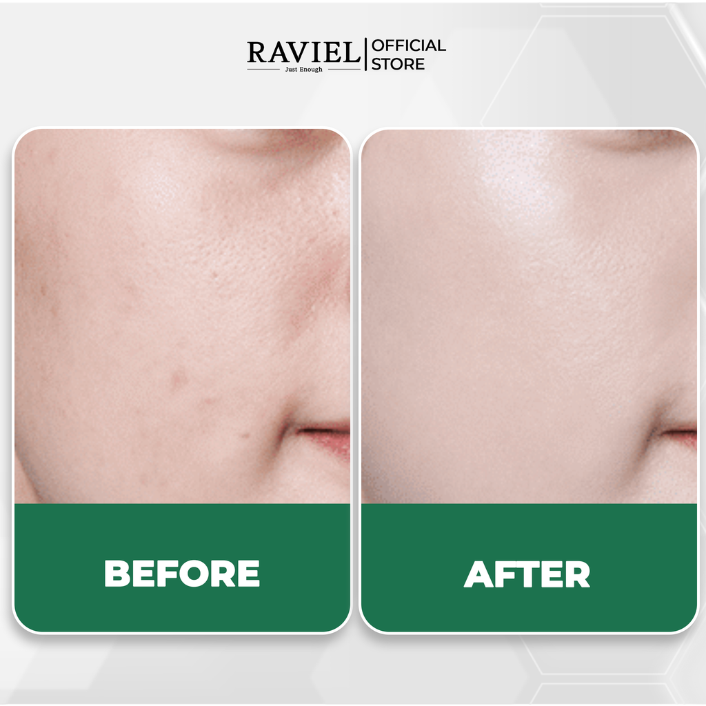 Kem làm dịu và phục hồi da mụn RAVIEL Green Derma Double Cica Cream Skin Protection Calming Fomula 50ml