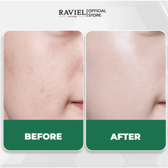 Kem làm dịu và phục hồi da mụn RAVIEL Green Derma Double Cica Cream Skin Protection Calming Fomula 50ml