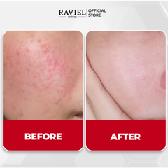 Kem đặc trị thâm, kháng viêm và ngăn ngừa mụn RAVIEL Panthenol Dark Spot & Blemish Spot Cream 15ml