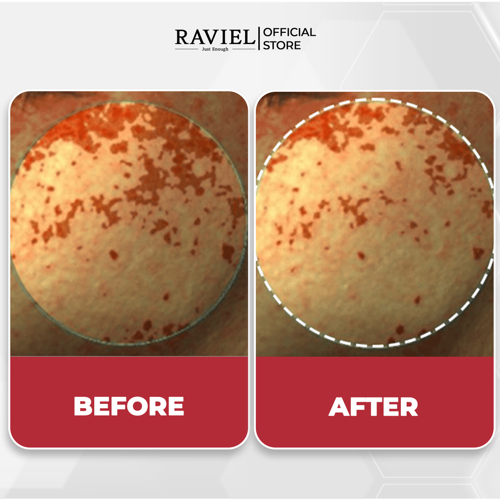 NHH dưỡng trắng trị thâm nám và tái tạo da RAVIEL Acerola Dark Spot & Blemish Care Toner 150ml