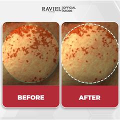 NHH dưỡng trắng trị thâm nám và tái tạo da RAVIEL Acerola Dark Spot & Blemish Care Toner 150ml