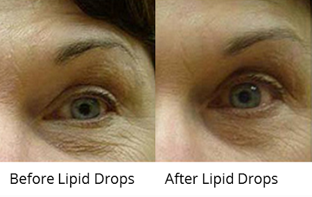  Lipid Drops 