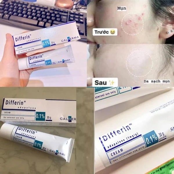 Gel Trị Mụn Galderma Differin 0.1% Adapalene Gel Acne Treatment 30g