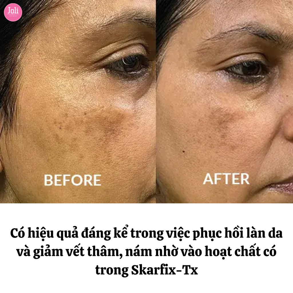 Kem Dưỡng Mờ Thâm Nám Tàn Nhang Fixderma Skarfix-TX Cream 15g