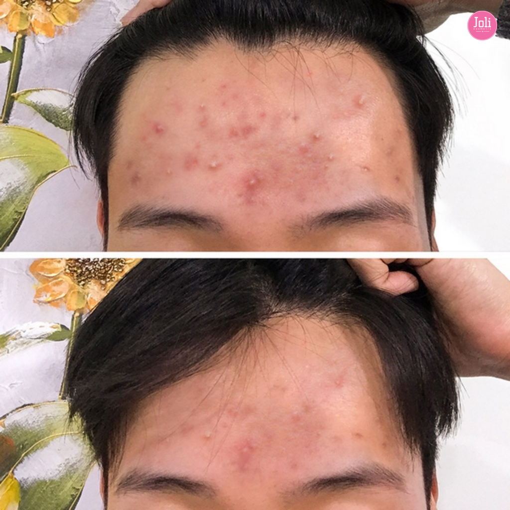 Sữa Rửa Mặt Cho Da Mụn Some By Mi AHA-BHA-PHA 30 Days Miracle Acne Clear Foam 100ml