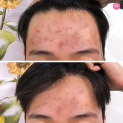 Sữa Rửa Mặt Cho Da Mụn Some By Mi AHA-BHA-PHA 30 Days Miracle Acne Clear Foam 100ml