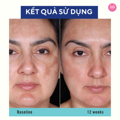 Kem Dưỡng Trắng Da Trị Sạm Nám Obagi Nu Derm BlendFx #5 57g