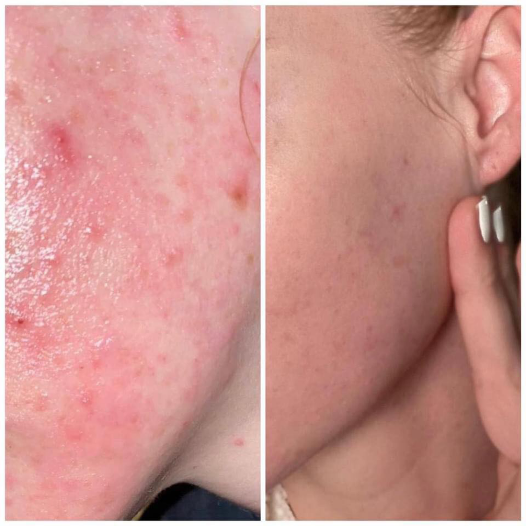 [Combo 2 Chai] Nước Hoa Hồng Cho Da Dầu Mụn SVR Sebiaclear Micro Peel (150ml x 2 )