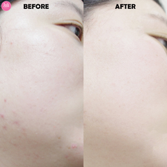 Kem Trị Mụn Ciracle Red Spot Cream 30g