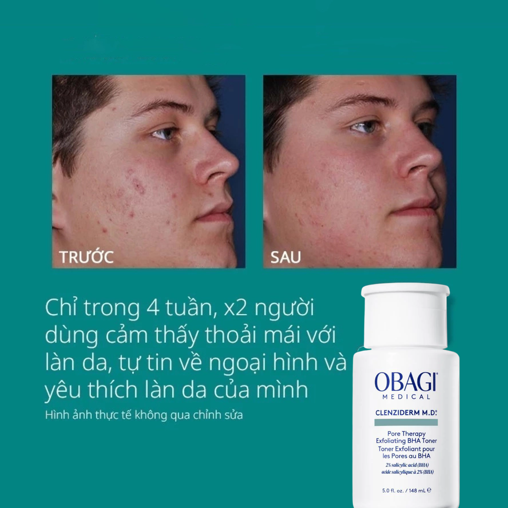 Nước Hoa Hồng Thu Nhỏ Lỗ Chân Lông Obagi Clenziderm M.D Pore Therapy Exfoliating BHA Toner 148ml