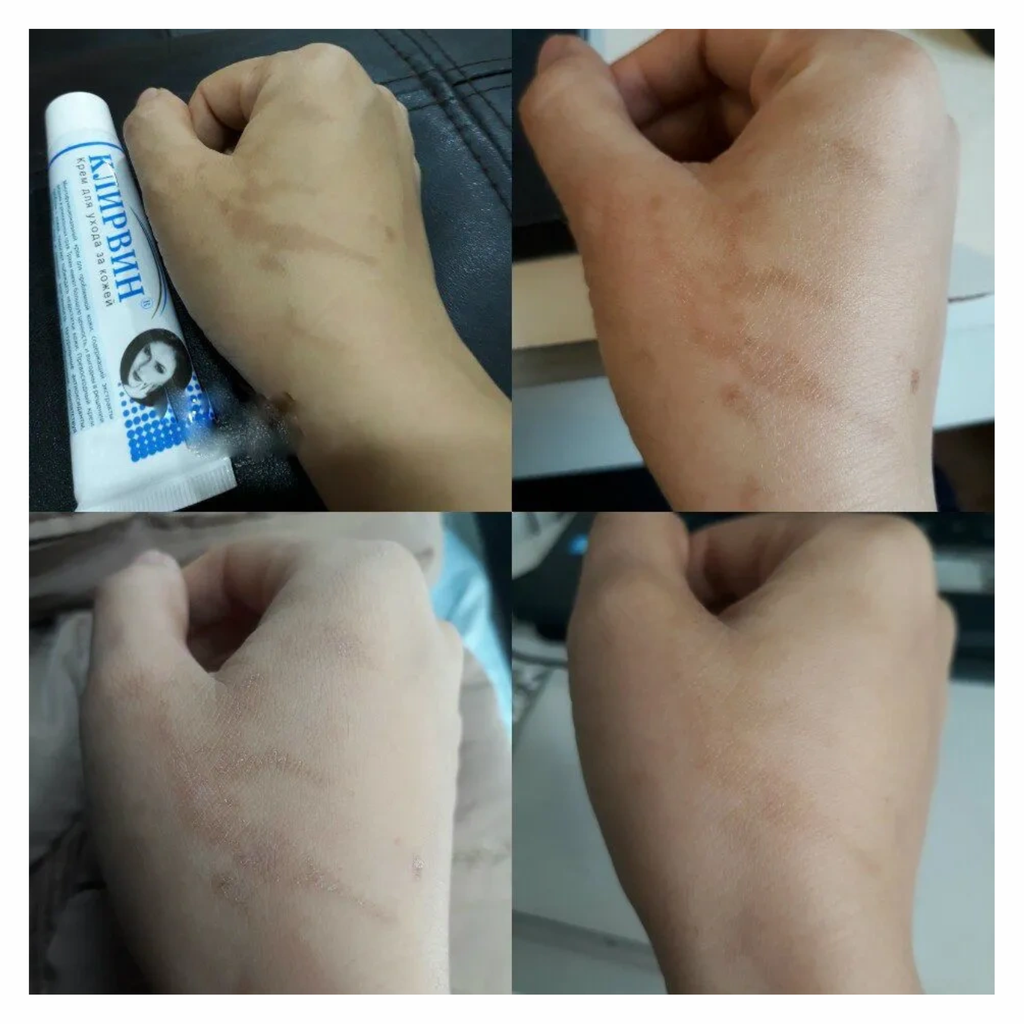 Kem Hỗ Trợ Trị Sẹo Klirvin 25g