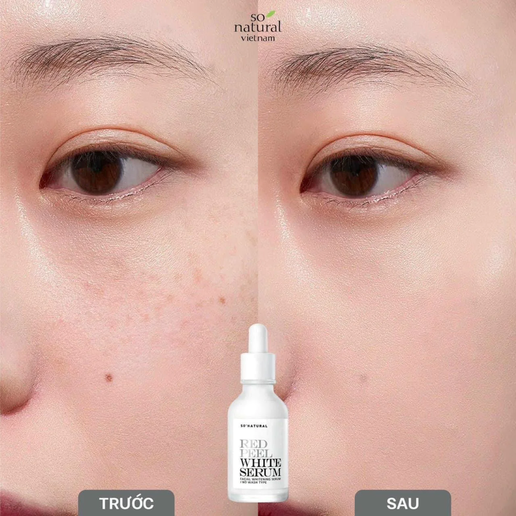 Tinh Chất Dưỡng Trắng Làm Đều Màu Da So Natural Red Peel White Serum