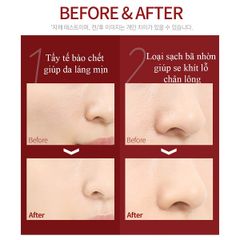 Tinh Chất Tẩy Da Chết So Natural Red Peel Tingle Serum Premium Texture 20ml