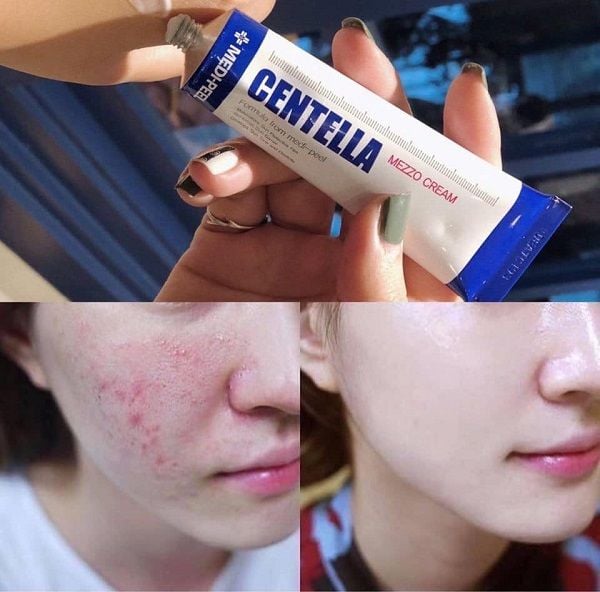 Kem Dưỡng Phục Hồi Cho Da Mụn Medi-Peel Centella Mezzo Cream 30ml