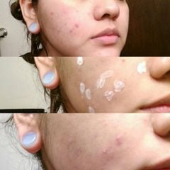 Bộ trị mụn Mario Badescu Skincare