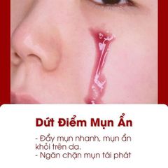 Tinh Chất Tẩy Da Chết Hóa Học So Natural Red Peel Tingle Serum