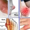 Thuốc trị bệnh Gout Hàn Quốc
