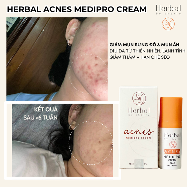  HERBAL ACNES MEDIPRO CREAM 