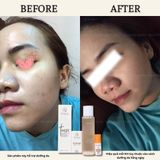  HERBAL ACNES MEDIPRO CREAM 