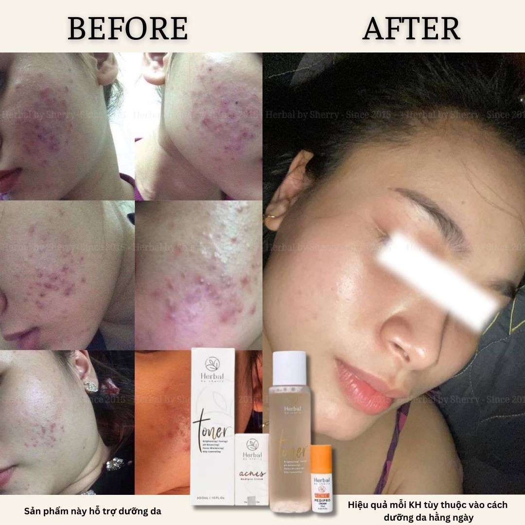  HERBAL TONER - Toner thảo dược 