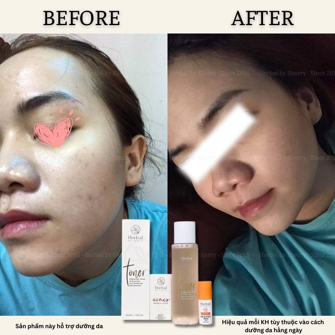  HERBAL TONER - Toner thảo dược 