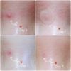 Set 5 miếng dán mụn Cosrx Acne Pimple Master Patch đỏ