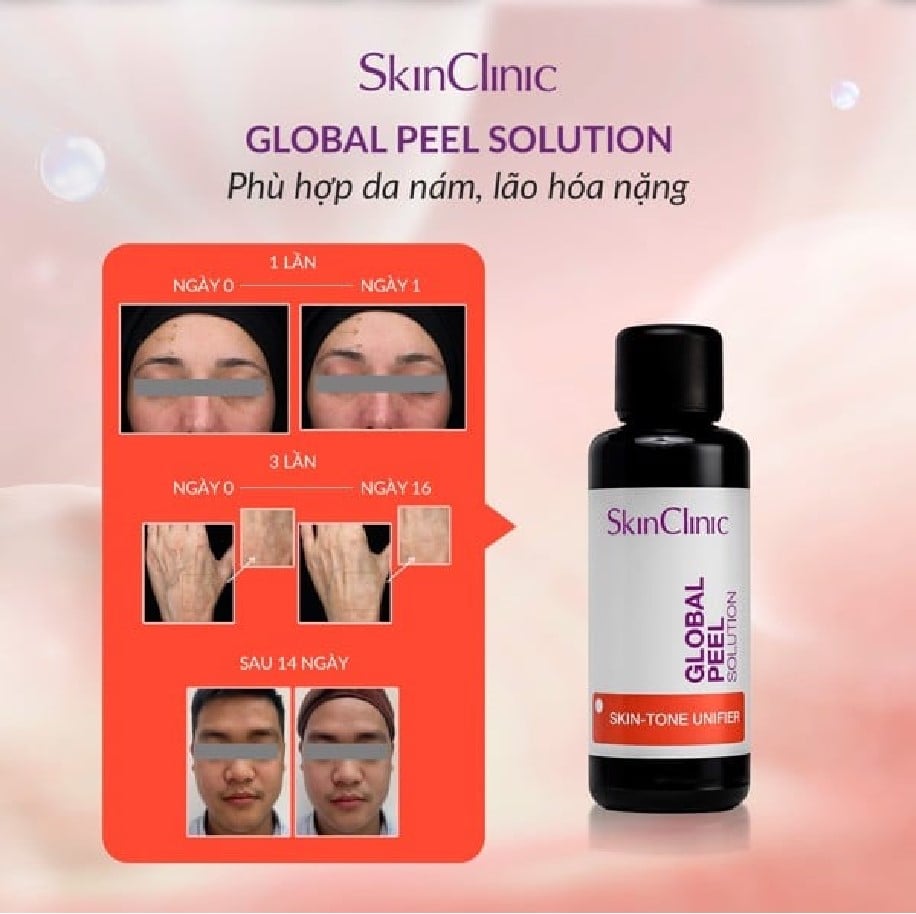Skin clinic Global Peel Solution - Peel Dành Cho Da Nám, Lão Hóa Nặng