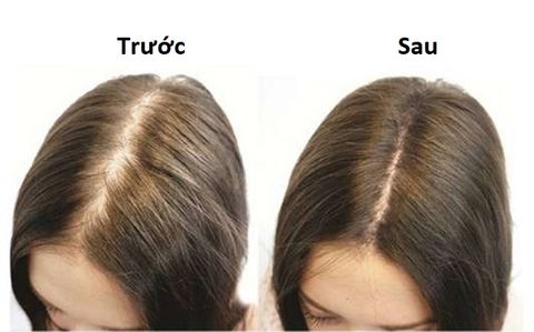 Viên Uống Hỗ Trợ Dưỡng Tóc Giảm Gãy Rụng - Martiderm Hair System Anti Hair-Loss Capsules (60 Viên)