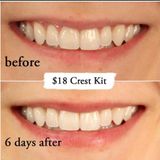  Miếng Dán Trắng Răng Crest 3D Whitestrips Professional White Level 18 Whiter 