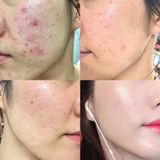  Kem Dưỡng Làm Dịu, Phục Hồi Da Chiết Xuất Rau Má Skin1004 Madagascar Centella Cream 75ml 