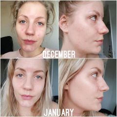 Tinh chất dưỡng The Ordinary Niacinamide 10% + Zinc 1% 30ml