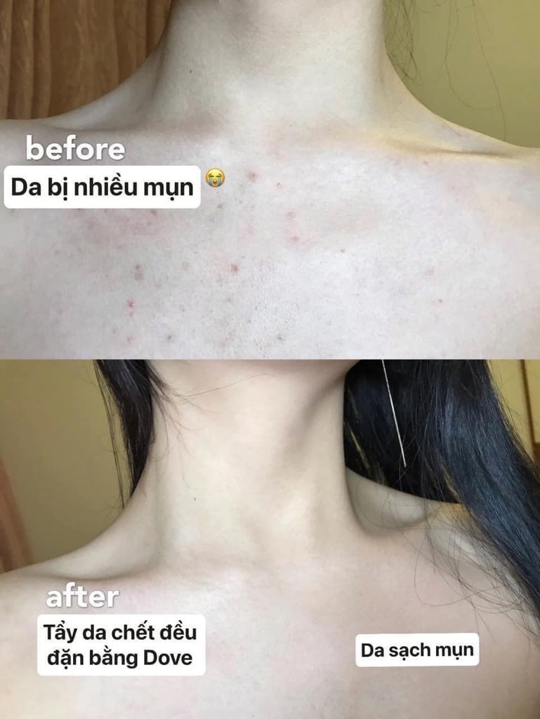 TẨY DA CHẾT TOÀN THÂN DOVE HŨ 225ML BẢN ĐỨC