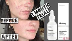 Tinh chất dưỡng The Ordinary Niacinamide 10% + Zinc 1% 30ml
