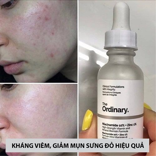Tinh chất dưỡng The Ordinary Niacinamide 10% + Zinc 1% 30ml
