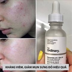 Tinh chất dưỡng The Ordinary Niacinamide 10% + Zinc 1% 30ml