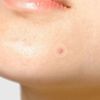 Miếng dán mụn Tiam Surprise H Patch (miếng)