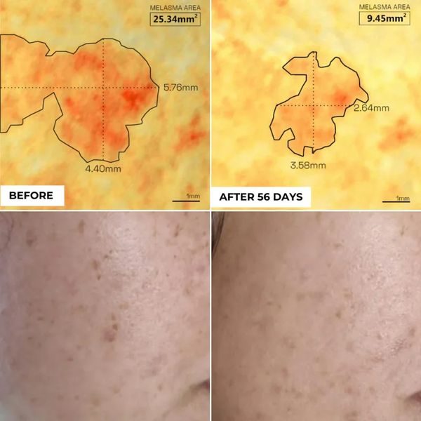 Serum Trị Thâm Nám Mạch, Thâm Mụn Đỏ 10ml | Derm Eden - Dark Spots Concentrate