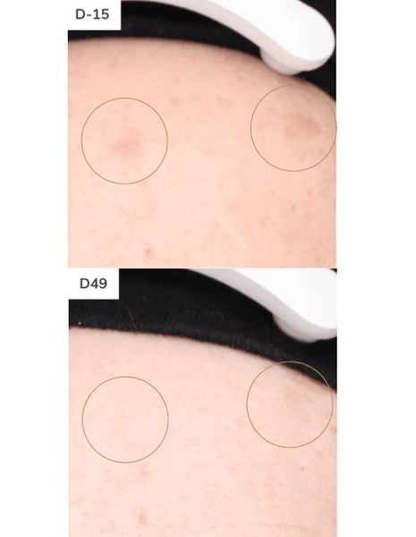 Tinh Chất Làm Sáng Da 5ml | Dermeden - Txa Nia 5.10 Sterile Trasepidermal Concentrate