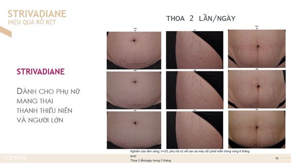Kem Trị Dạn Da Noreva Strivadiane Concentrated Anti Stretch Mark Care |125ml