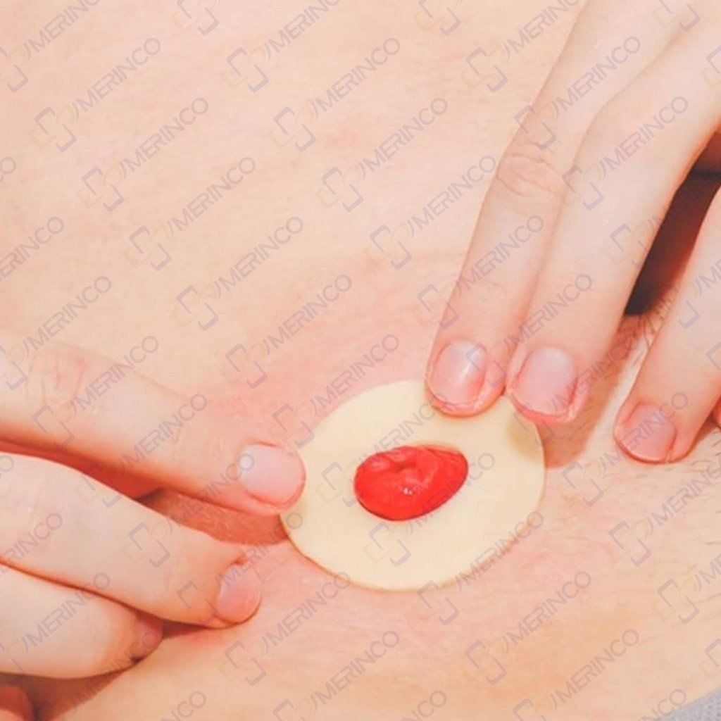 Vòng bảo vệ da chống loét hậu môn nhân tạo Hollister 7806