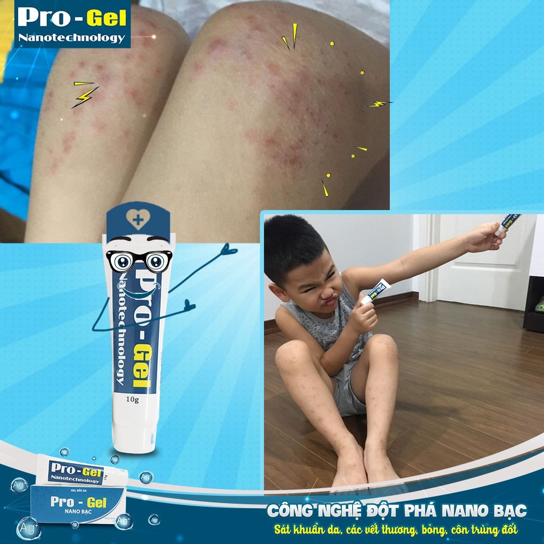  Pro - Gel Nano Bạc: Kem Bôi Bỏng, Hăm Da, Tay Chân Miệng, Côn Trùng Đốt, Mụn Nhọt, Vết Thương Hở 