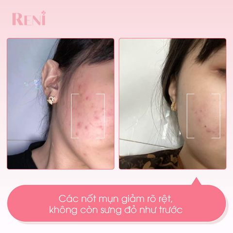  Combo Sữa rửa mặt + Serum Reni 