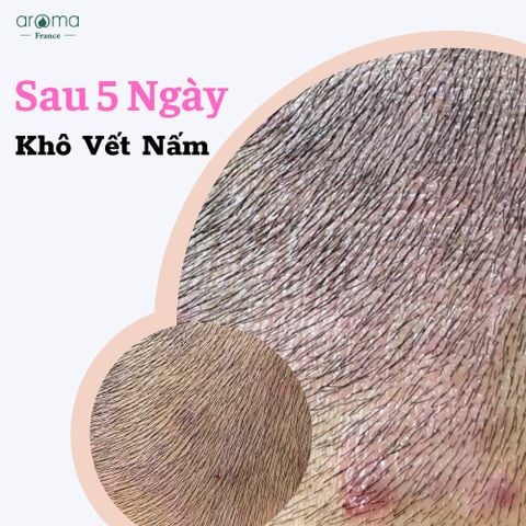 DẦU THIÊN NHIÊN TOONIC TRỊ GÀU, NẤM DA ĐẦU, VẢY NẾN, CHÀM, NẤM MÓNG