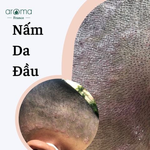 DẦU THIÊN NHIÊN TOONIC TRỊ GÀU, NẤM DA ĐẦU, VẢY NẾN, CHÀM, NẤM MÓNG