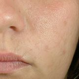  Serum Kiểm Soát Bã Nhờn, Ngăn Ngừa Mụn Blemish + Age Defense Skinceuticals 